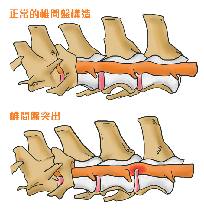什麼！寵物也會椎間盤突出？-椎間盤側面圖