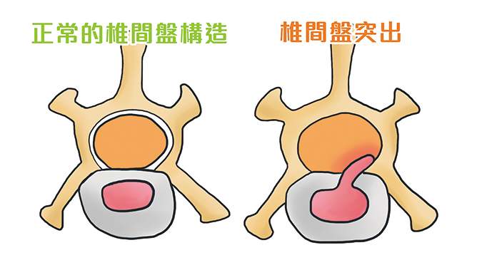 什麼！寵物也會椎間盤突出？-椎間盤切面圖